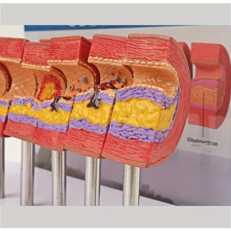 Educational Arterial Sclerosis Model for Students