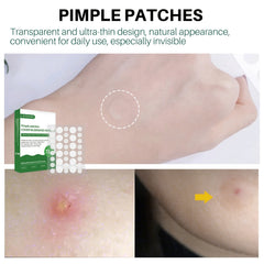 72 Pcs Pimple Patches Hydrocolloid Acne Stickers For Covering Zits Blemishes