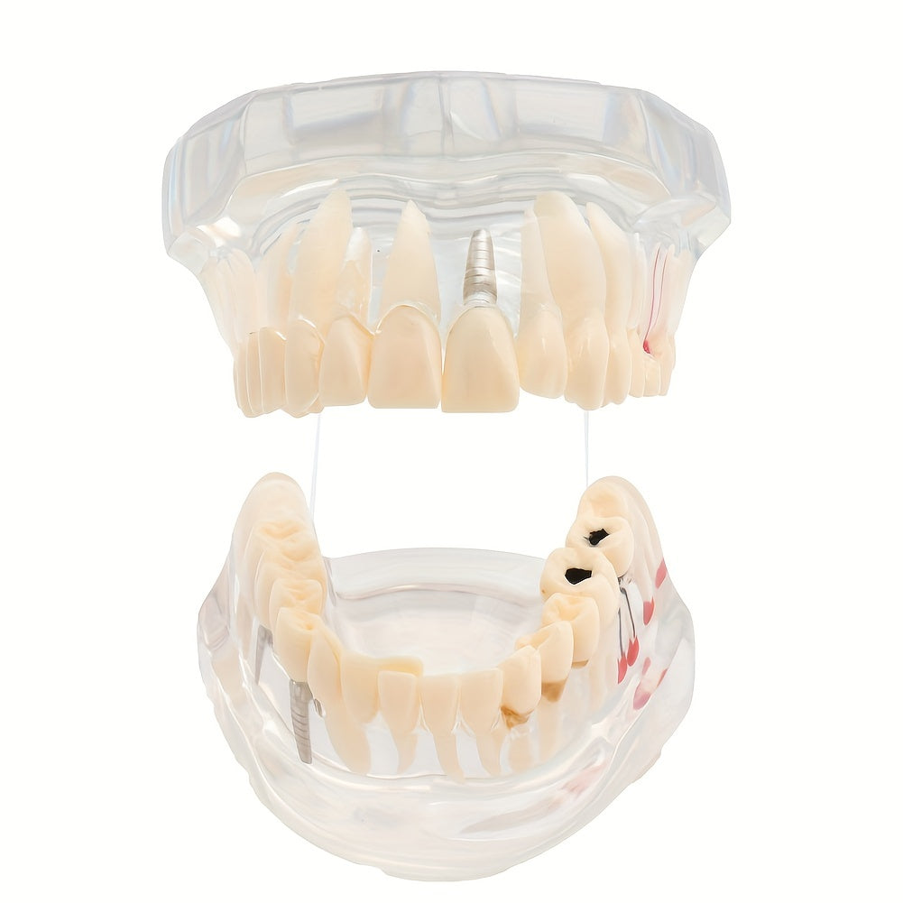 Dental Restoration Model Pathological Tooth Model Implant Tooth Model