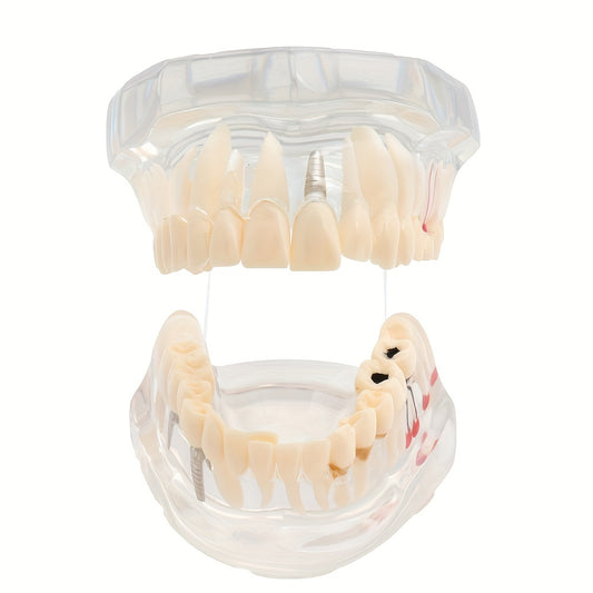 Dental Restoration Model Pathological Tooth Model Implant Tooth Model