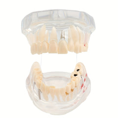 Dental Restoration Model Pathological Tooth Model Implant Tooth Model