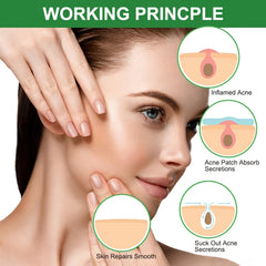 Acne Pimple Patch 24 Patches Hydrocolloid Spot Care Sticker
