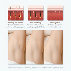 Laser Hair Removal Device - Permanent Hair Removal At Home