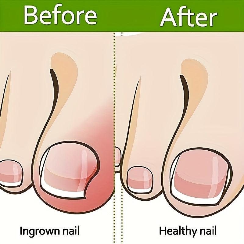 Ingrown Toenail Corrector Brace Strips Pedicure Tool Toenail Correction Patch