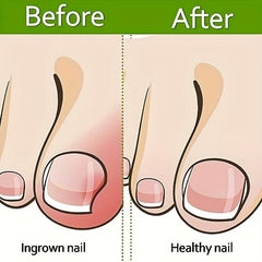 Ingrown Toenail Corrector Brace Strips Pedicure Tool Toenail Correction Patch