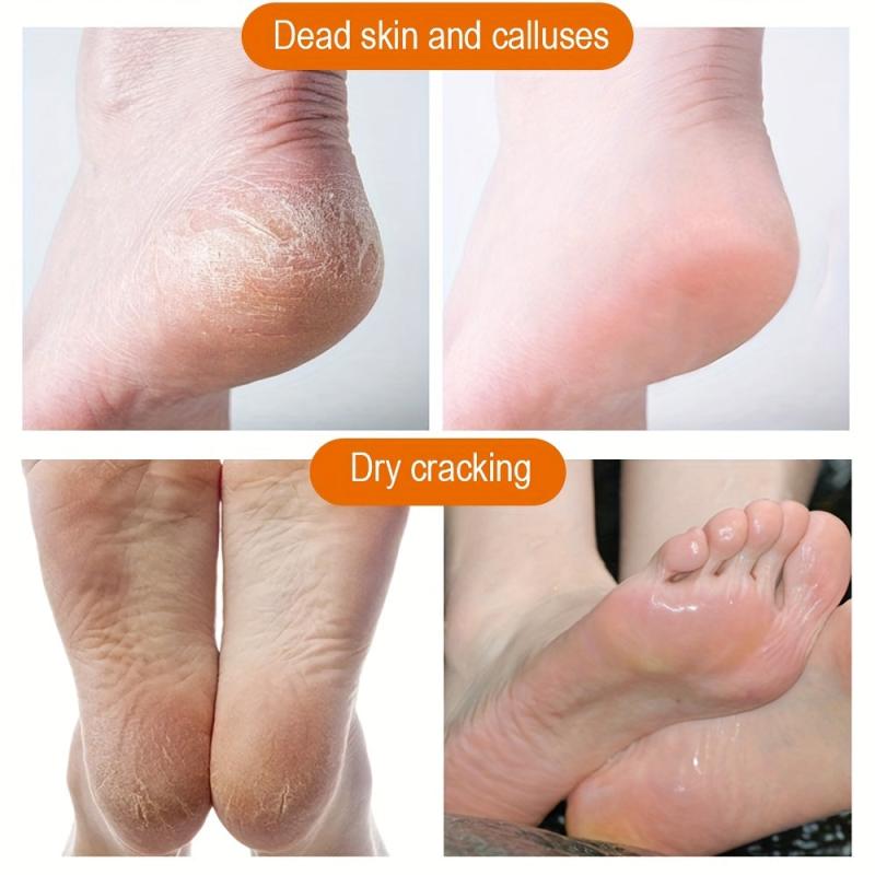 Anti Crack Cream for Feet - Softens Dead Skin and Calluses - 50g