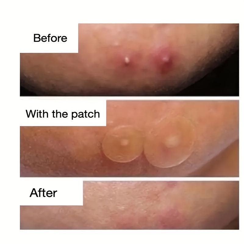 Hydrocolloid Acne Pimple Patch For Concealing Spots