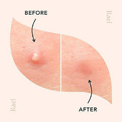 36 48pcs Pimple Patches Hydrocolloid Acne Patches For Face