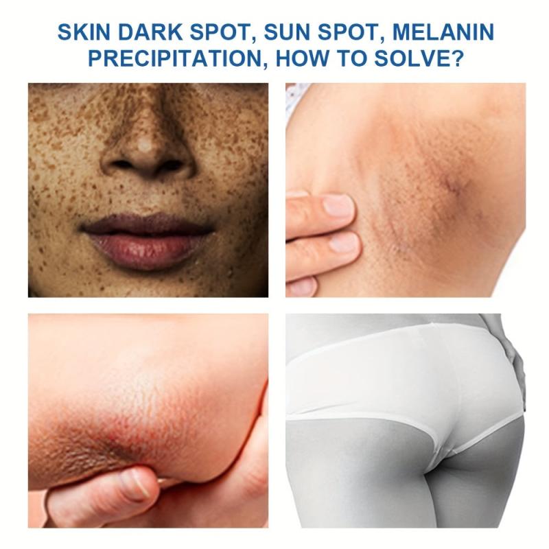 Freckle Cream Remove Acne Spots Moisturize And Smooth Skin