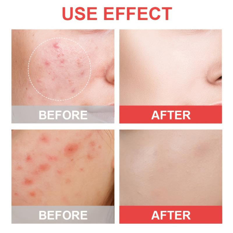 Acne Patch Pimple Patches For Face Hydrocolloid Spot Stickers With Tea Tree Sali