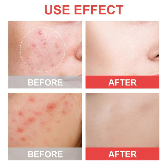 Acne Patch Pimple Patches For Face Hydrocolloid Spot Stickers With Tea Tree Sali