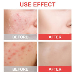 Acne Patch Pimple Patches For Face Hydrocolloid Spot Stickers With Tea Tree Sali