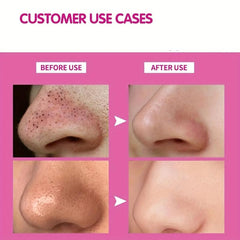 Blackhead Cleansing Nose Patch Acne Peeling Mask Skin Care