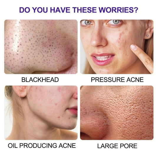 6 Charcoal Pore Strips for Blackhead Removal on Oily Skin
