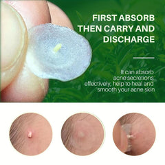 72 Pcs Pimple Patches Hydrocolloid Acne Stickers For Covering Zits Blemishes