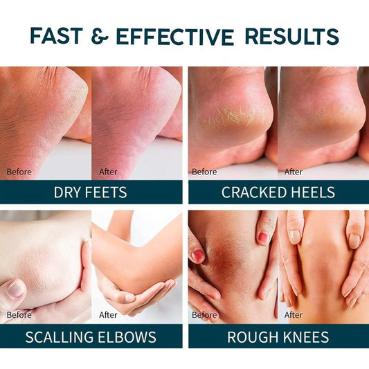 Urea Cream w/ 2% Salicylic Acid for Cracked Feet - Foot Moisturizer