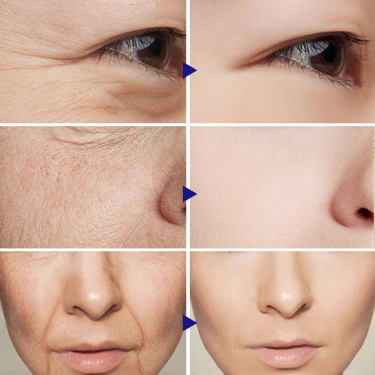 10Pcs Collagen Smile Line Patch For Facial Smile Line Lifting