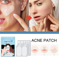 EELHOE Invisible Acne Patch 80 Stickers Waterproof Concealer
