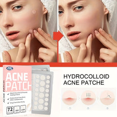 Acne Pimple Patch 72 Pcs Hydrocolloid Spot Stickers Vegan