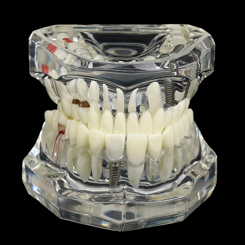 Dental Restoration Model Pathological Tooth Model Implant Tooth Model