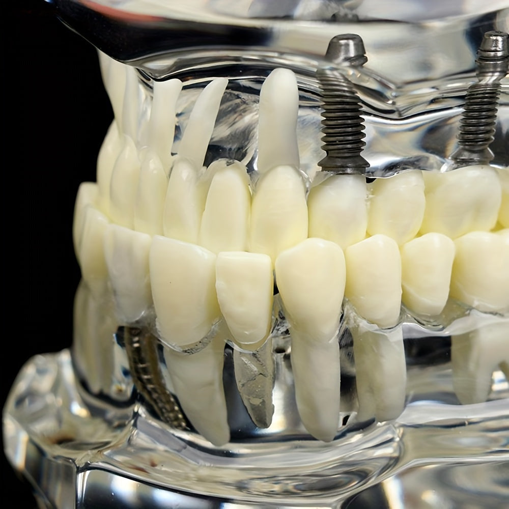 Dental Restoration Model Pathological Tooth Model Implant Tooth Model