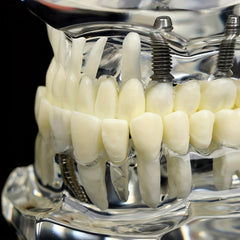 Dental Restoration Model Pathological Tooth Model Implant Tooth Model