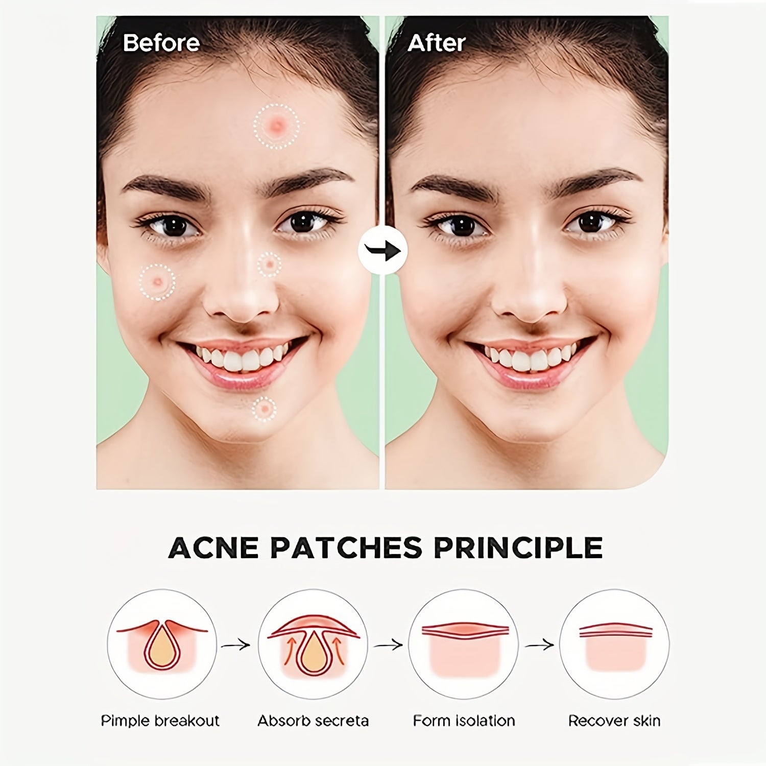 Hydrocolloid Acne Patches - Cover Zits and Blemishes