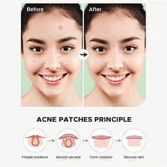 Hydrocolloid Acne Patches - Cover Zits and Blemishes