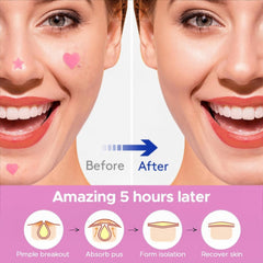 360 Counts Pink Heart & Star Shaped Acne Patch Hydrocolloid Acne Patches